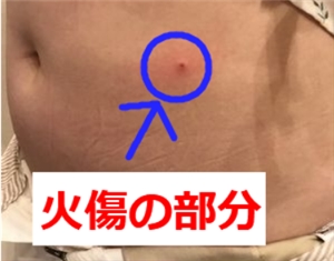 VアップシェイパーEMSでやけどをした画像