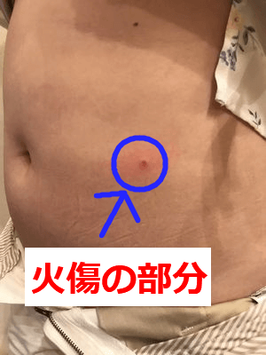 VアップシェイパーEMSを使用してできた火傷の写真